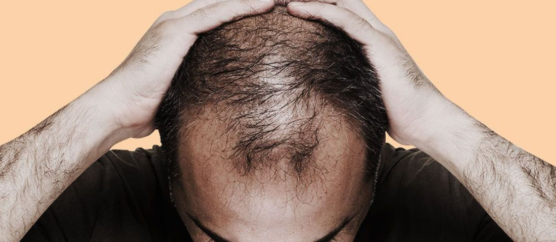 Effective Hair Regrowth with Minoxidil Topical Solution USP 5%