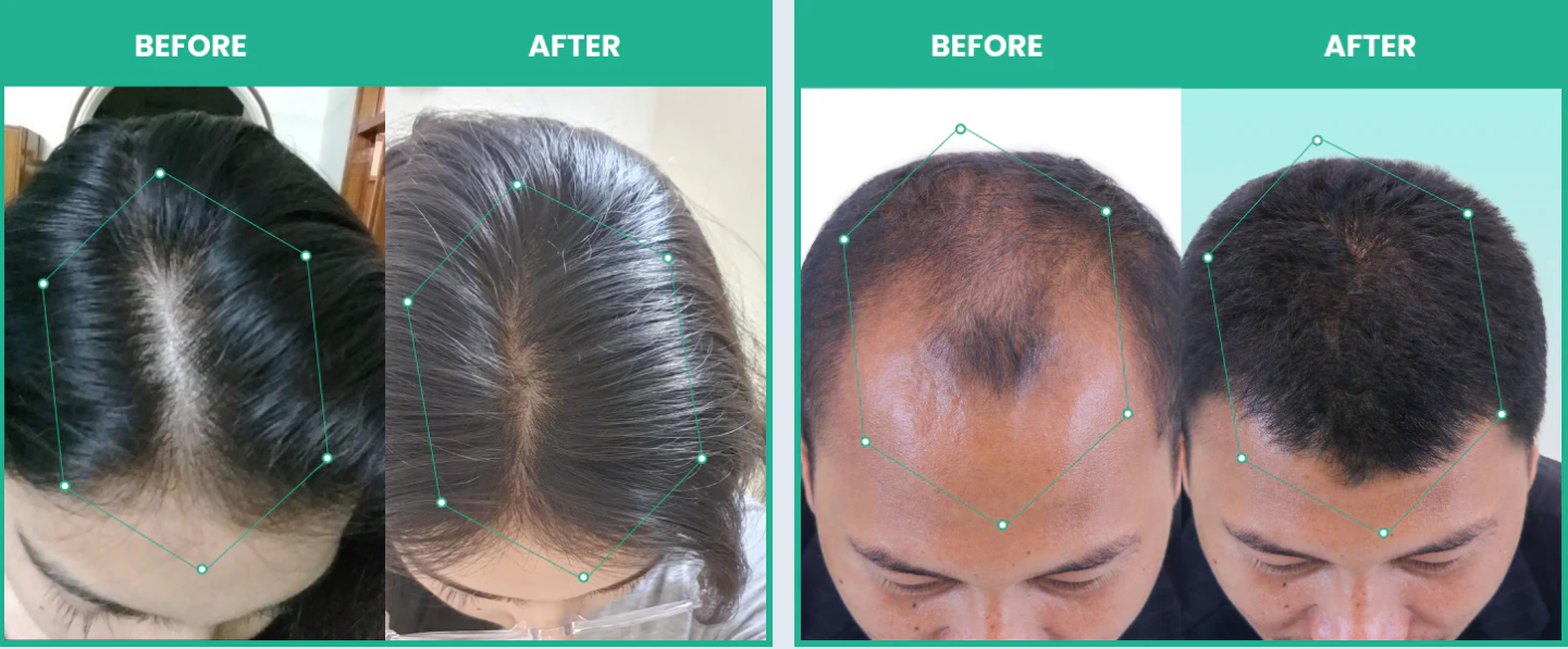 Tress Gain | Hair Growth Serum | 5 Hair Store Formulation for Men & Women | Minoxidil Topical Solutions USP 5%